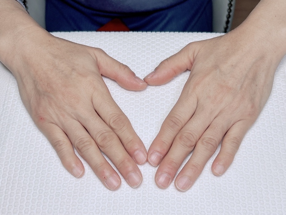 まずは　施術前の　私の手　冬になると　さかむけがあるのは　いつものこと　二枚爪も当たり前に